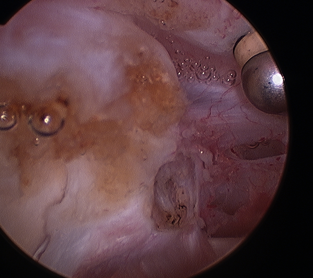 Arthroscopy Biceps Tenotomy